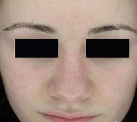 woman with acne after aerolase treatment