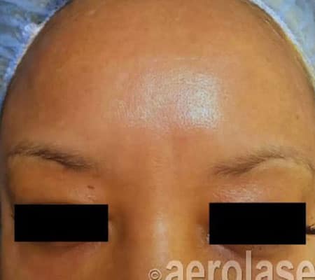 woman with melasma after aerolase treatment