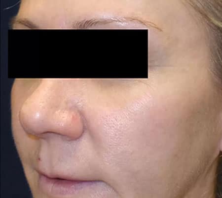 woman after aerolase treatment