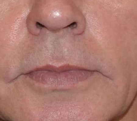 man with rosacea after aerolase treatment
