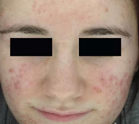 woman with acne before aerolase treatment