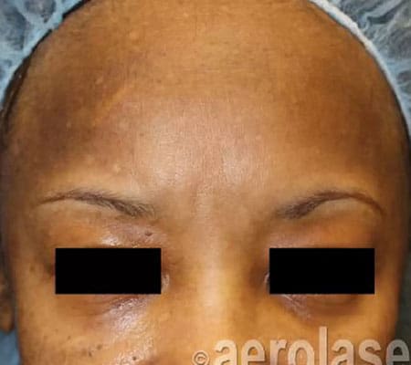 woman with melasma after aerolase treatment