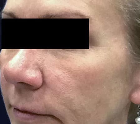 woman before aerolase treatment