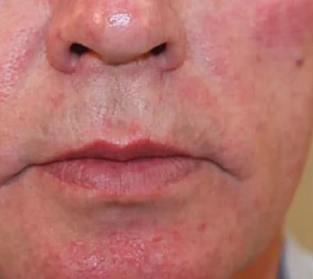 man with rosacea before aerolase treatment
