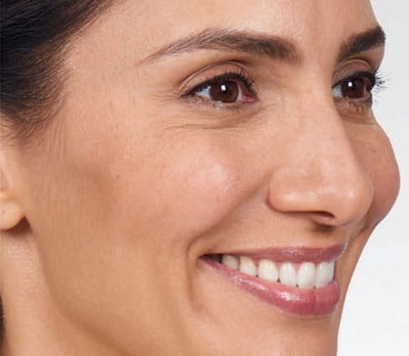 woman's face after botox
