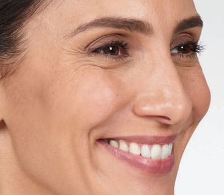 woman's face before botox