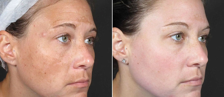 woman with brown spots removed
