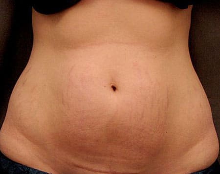 woman's abdomen after combination treatment