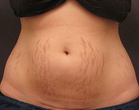 woman's abdomen before combination treatment