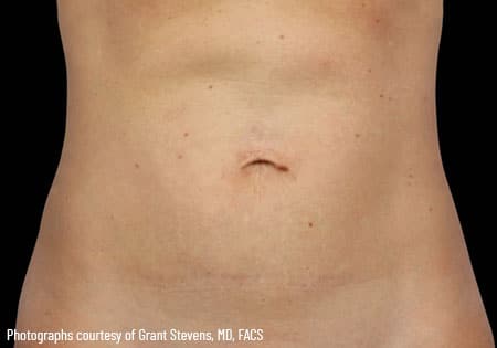 woman's stomach after coolsculpting