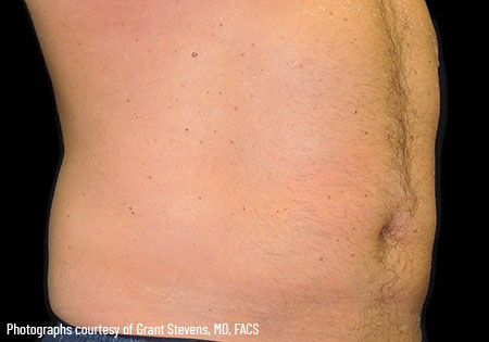man's stomach after coolsculpting