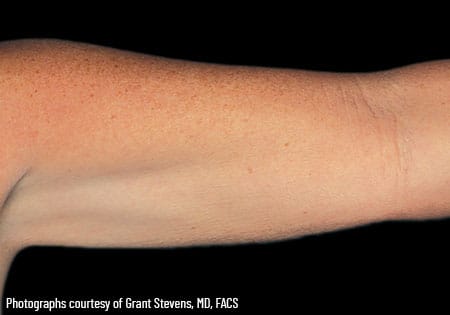 woman's arm after coolsculpting