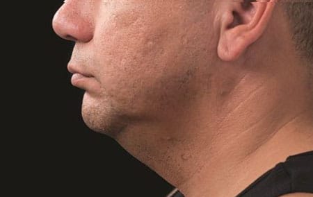 man with double chin after coolsculpting treatment