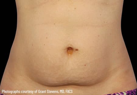 woman's stomach before coolsculpting