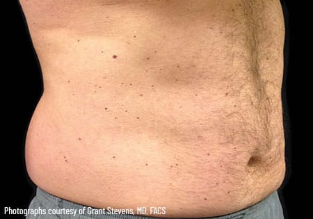 man's stomach before coolsculpting