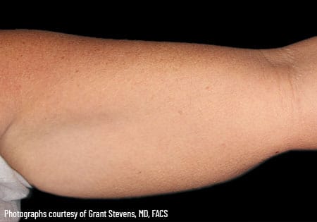 woman's arm before coolsculpting