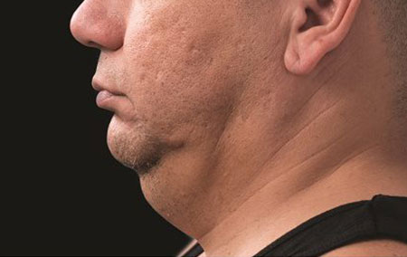 man with double chin before coolsculpting treatment