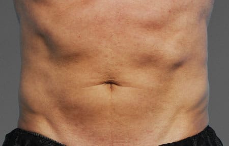 man's abdomen after cooltone treatment