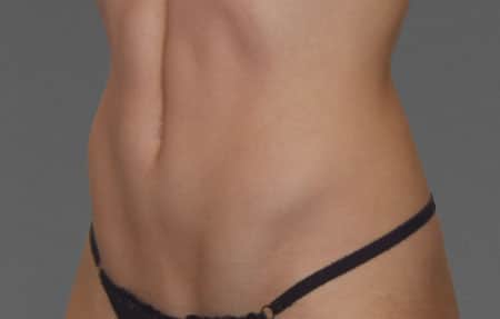 woman's abdomen after cooltone treatment
