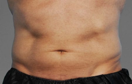 man's abdomen before cooltone treatment