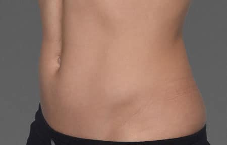 woman's abdomen before cooltone treatment