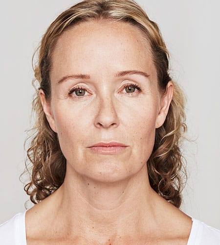 woman's face after dysport