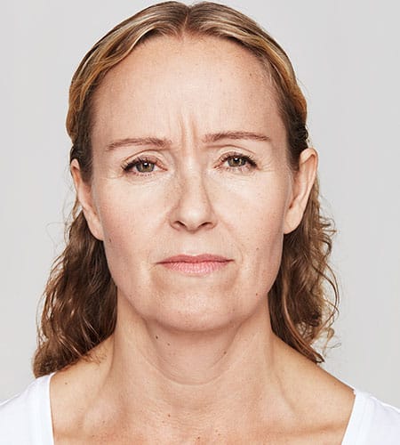 woman's face before dysport