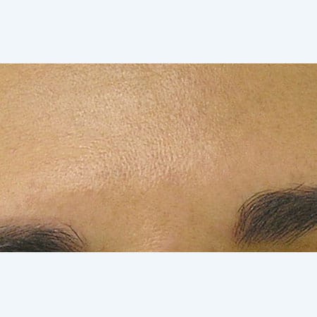 woman's face after hydrafacial