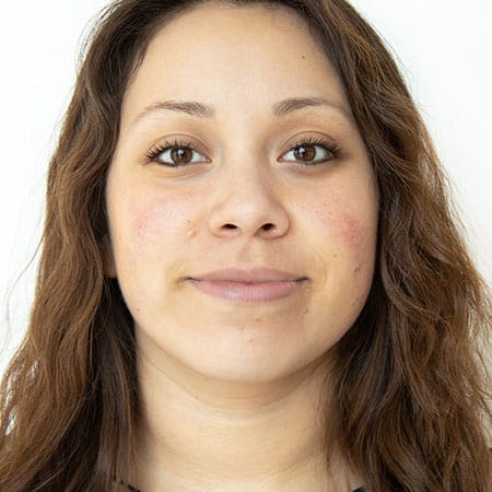 woman's face before hydrafacial