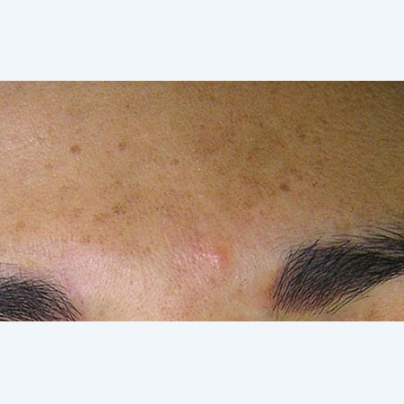 woman's face before hydrafacial