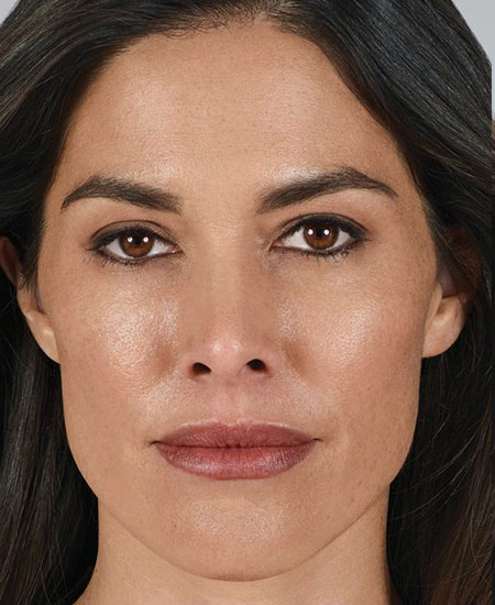 woman's face after juvederm