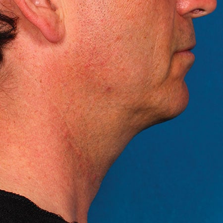 man's face after kybella