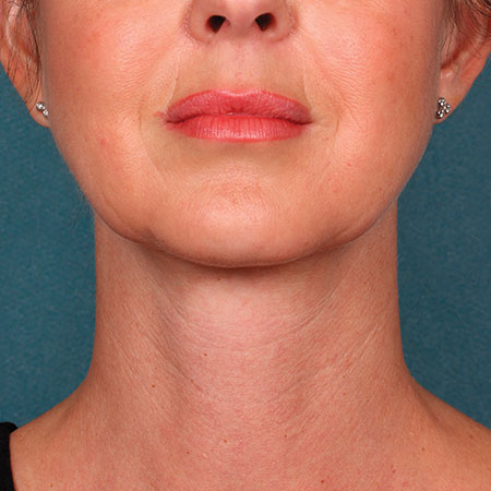 woman's face after kybella