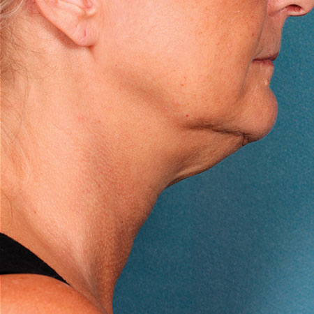 woman's face before kybella