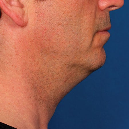 man's face before kybella