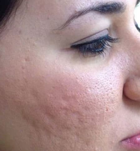 woman's face after microneedling treatment
