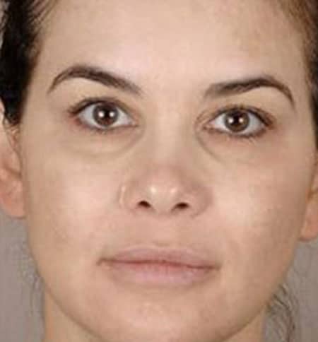 woman's face after microneedling treatment