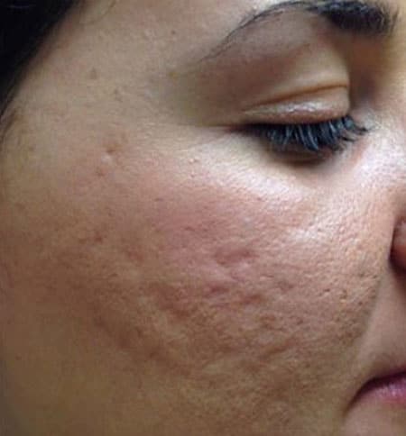 woman's face before microneedling