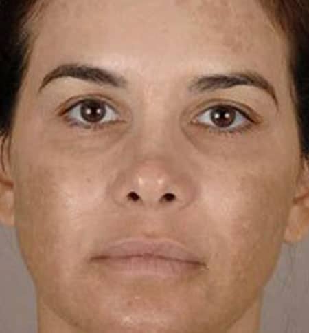 woman's face before microneedling