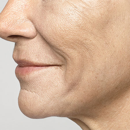 woman's face after restylane