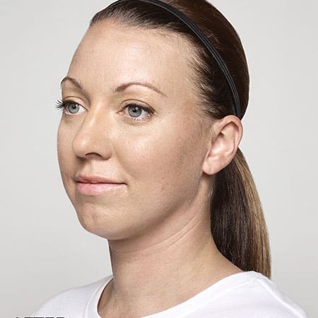 woman's face after restylane