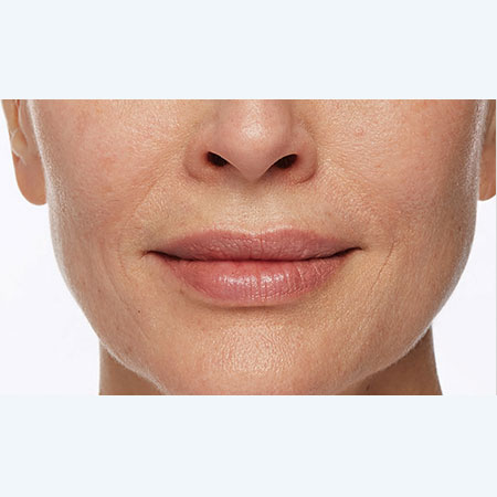 woman's face after restylane