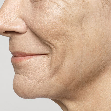 woman's face before restylane