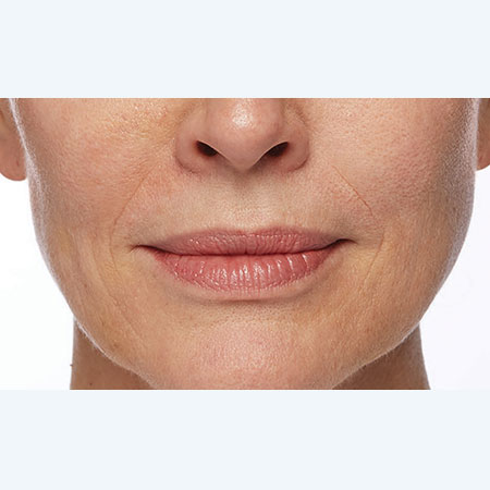 woman's face before restylane