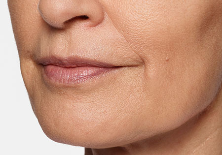 woman's face after restylane silk