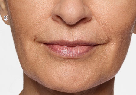 woman's face after restylane silk