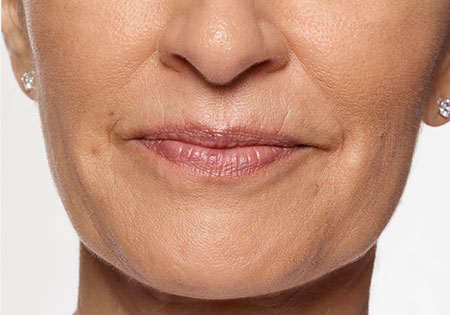 woman's face before restylane silk