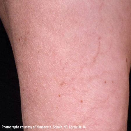woman's leg after sclerotherapy