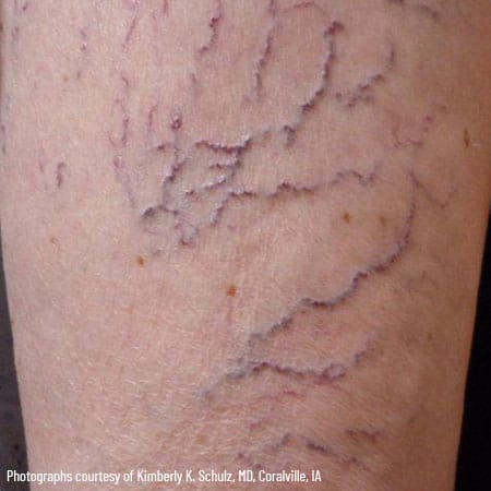woman's leg with spider veins