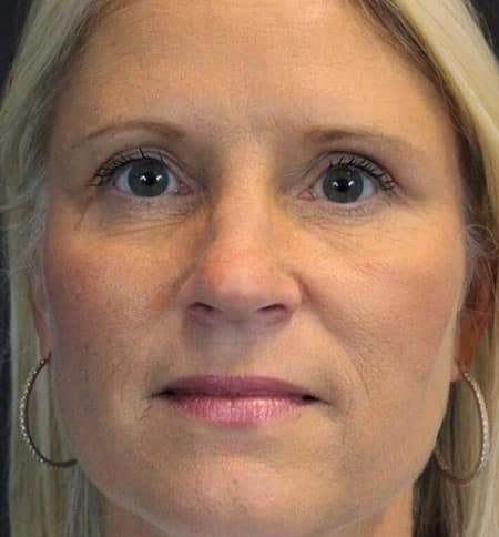 woman's face after thread lift
